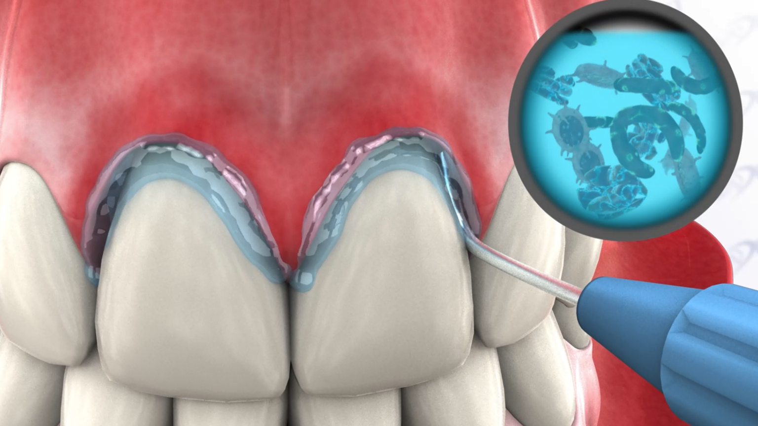 Periowave™ Procedure - Two Upper Central Incisors