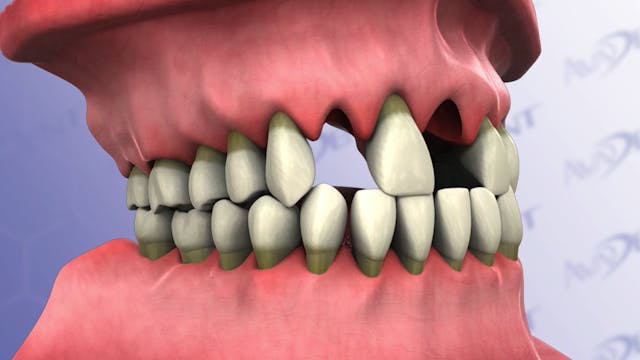 Periodontal Disease