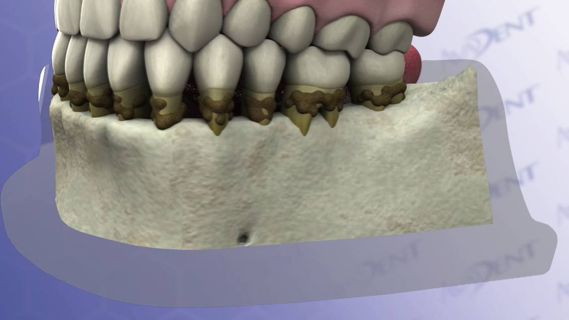 Horizontal Bone Loss