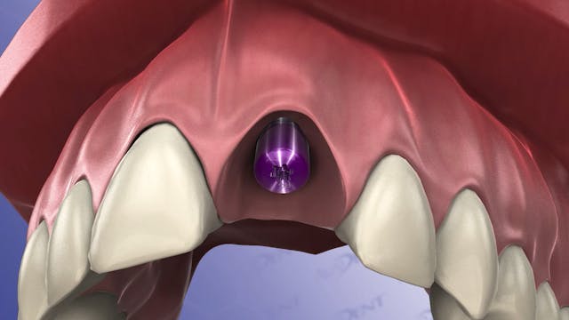 Implant Placement into Socket