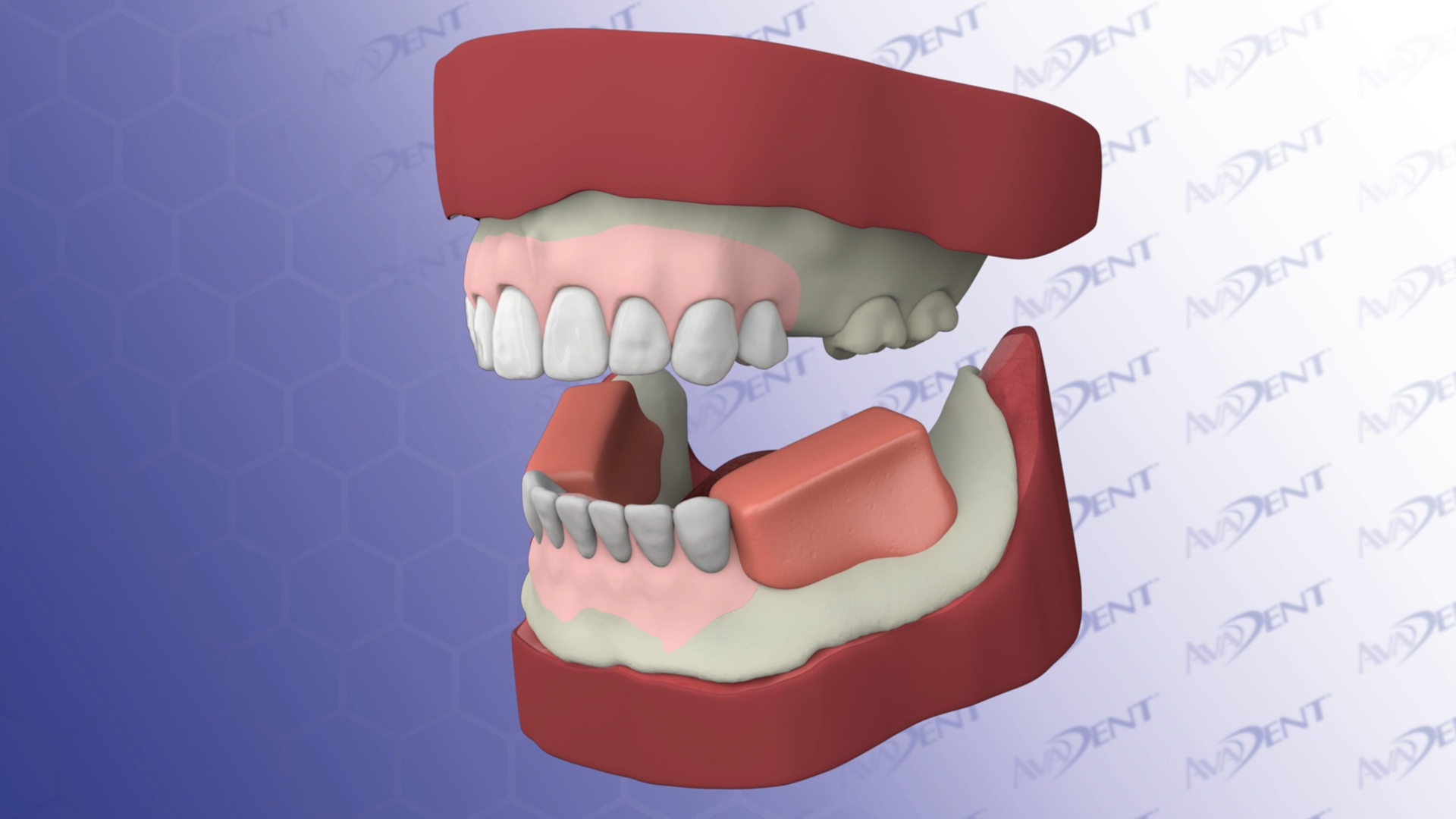 WTI Three-Appointment Denture Workflow