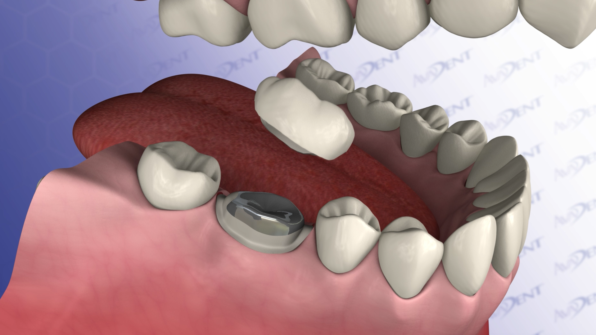 Lower Posterior Crown