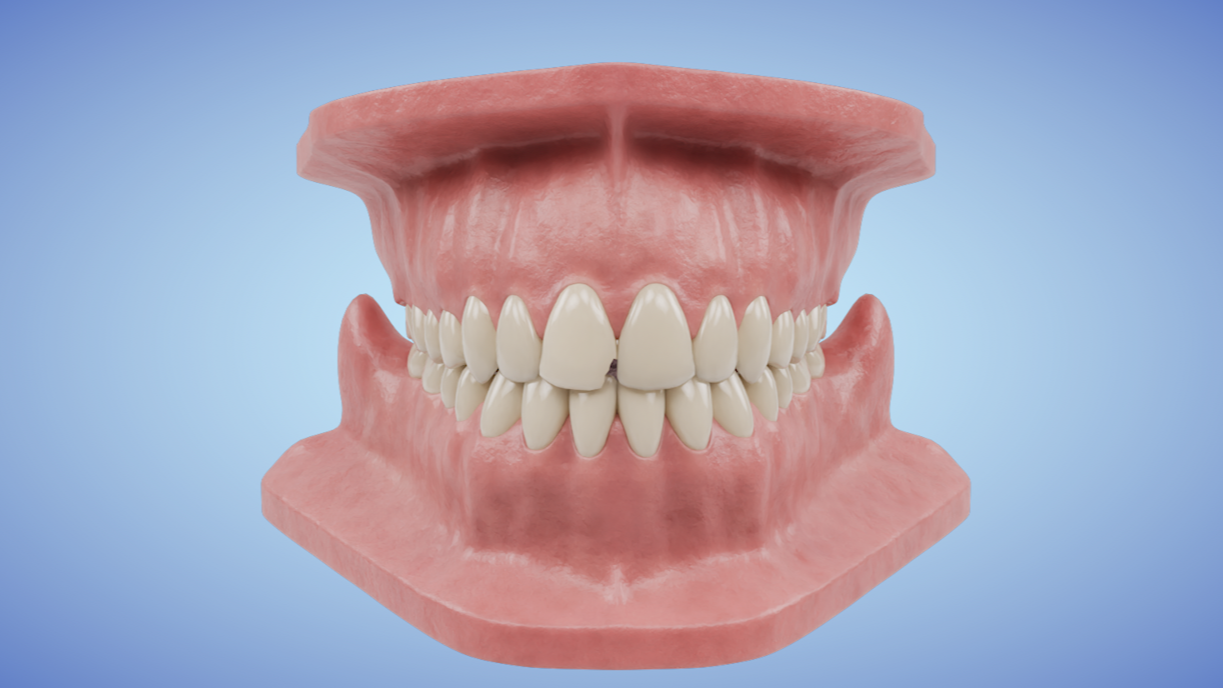 Single Crown Chipped Tooth