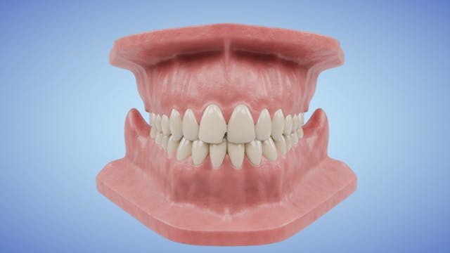 Single Crown Chipped Tooth