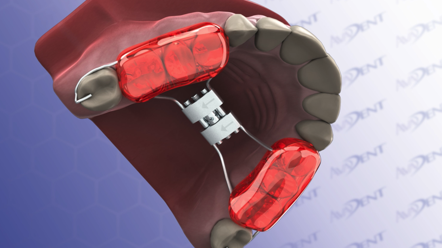 Bonded Rapid Palatal Expander - Orthodontic Appliance