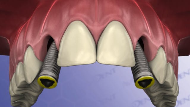 Congenitally Missing Laterals