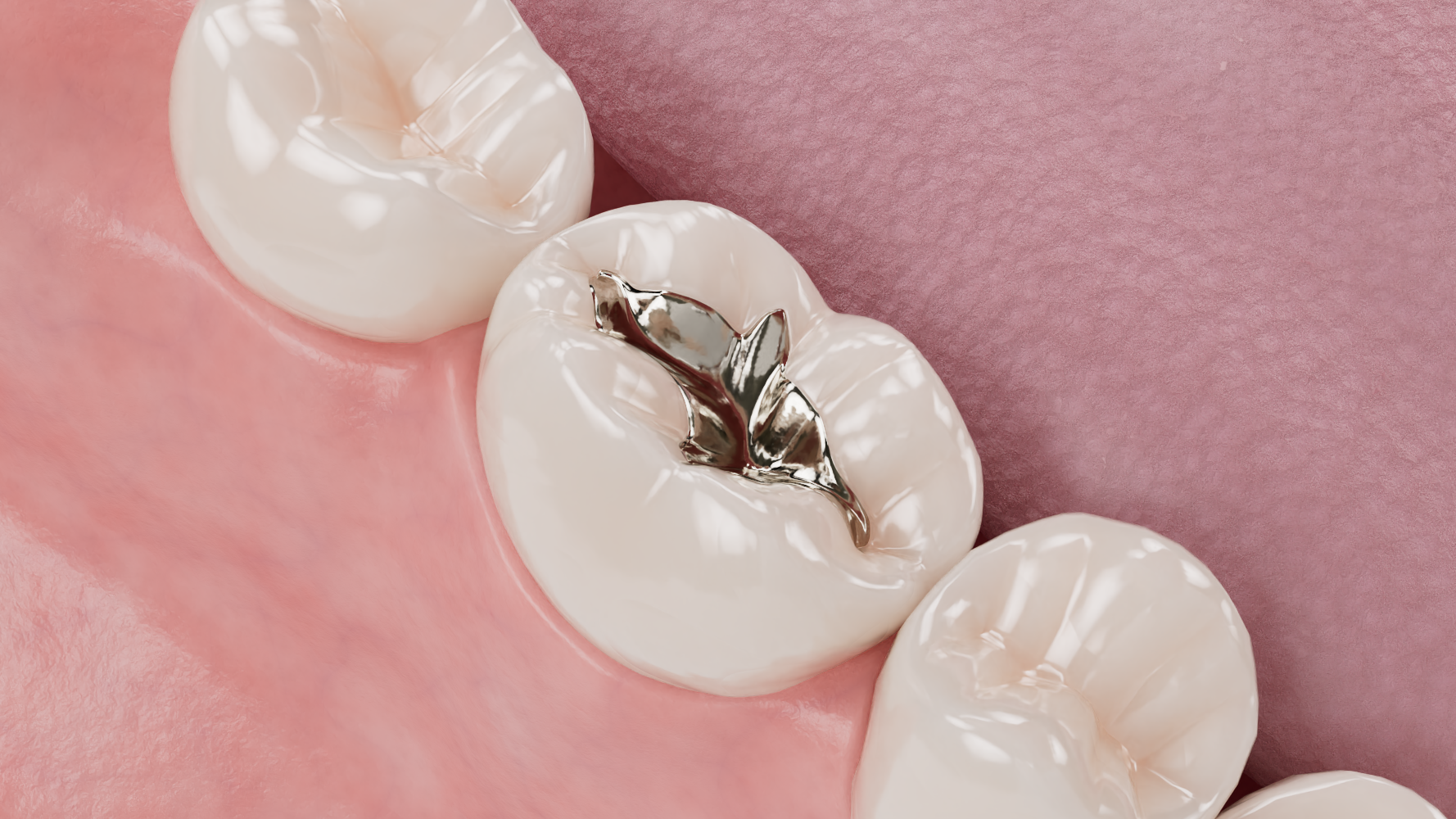 Replacing an Amalgam Filling