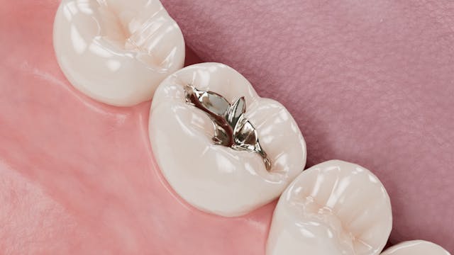 Replacing an Amalgam Filling