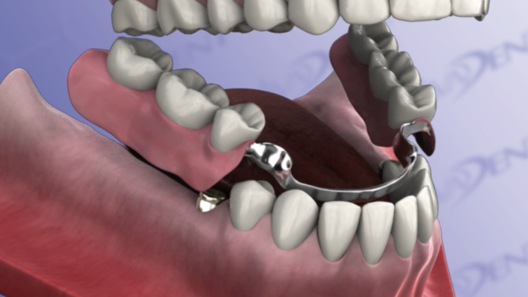 Partial Denture with Implants