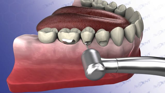 Fillings On Multiple Teeth - Replacin...