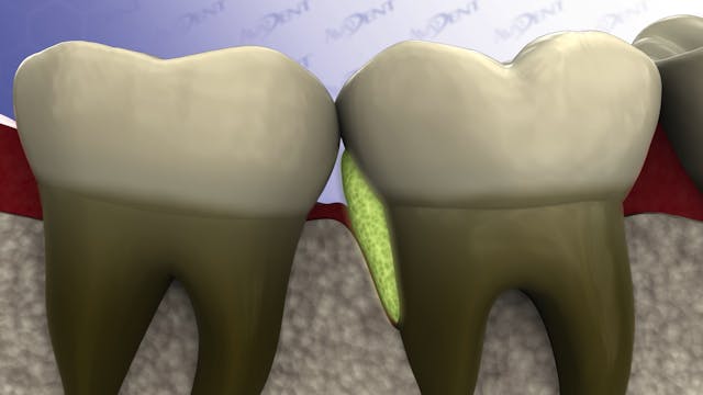 Vertical Bone Loss