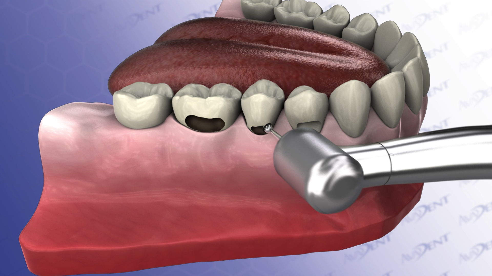 Fillings On Multiple Teeth - Decayed and Damaged