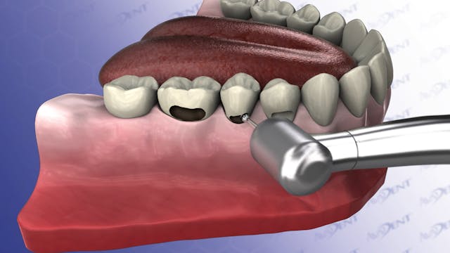 Fillings On Multiple Teeth - Decayed ...