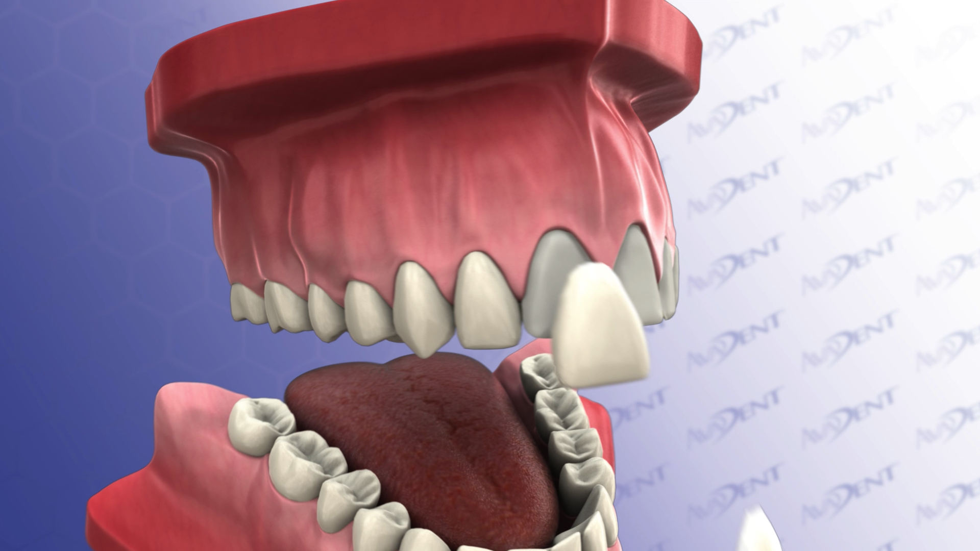 Veneers on Upper Anterior Teeth