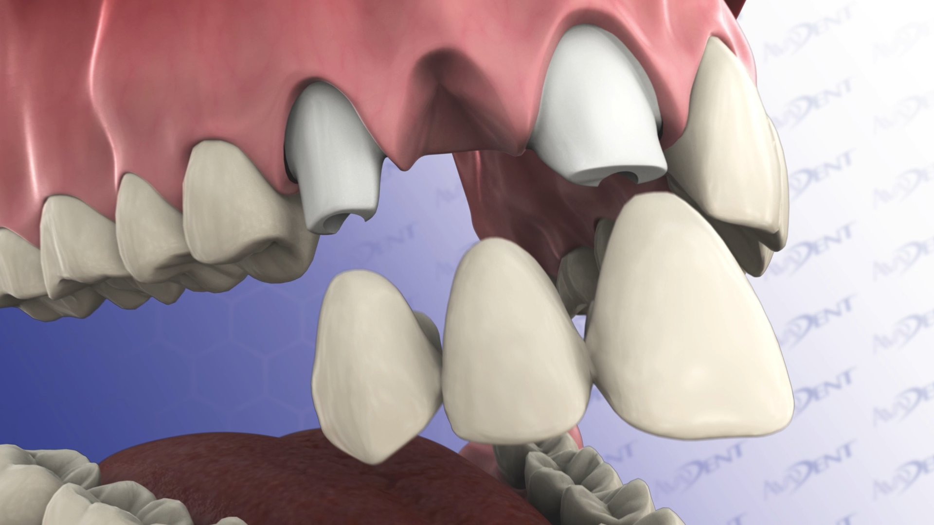 Anterior Implant Supported Three-Unit Bridge