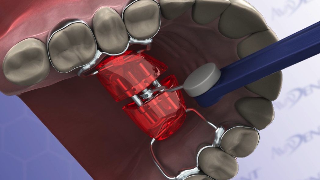 Haas Expander Orthodontic Appliance