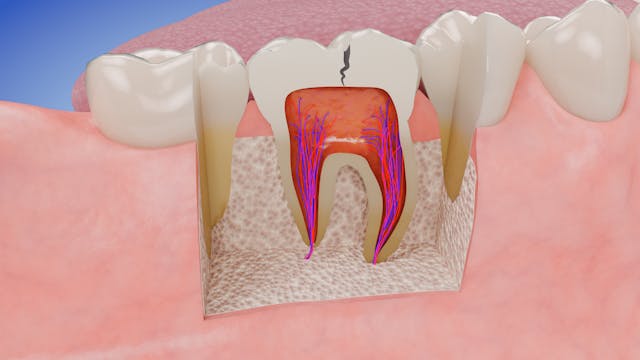 Cross Section of Infected Tooth