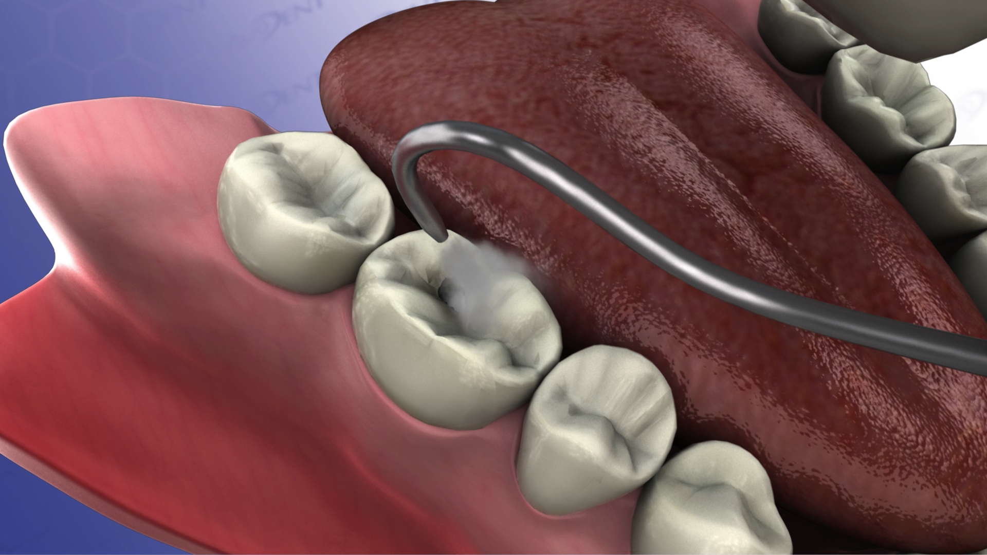 Conservative Air Abrasion Preperation