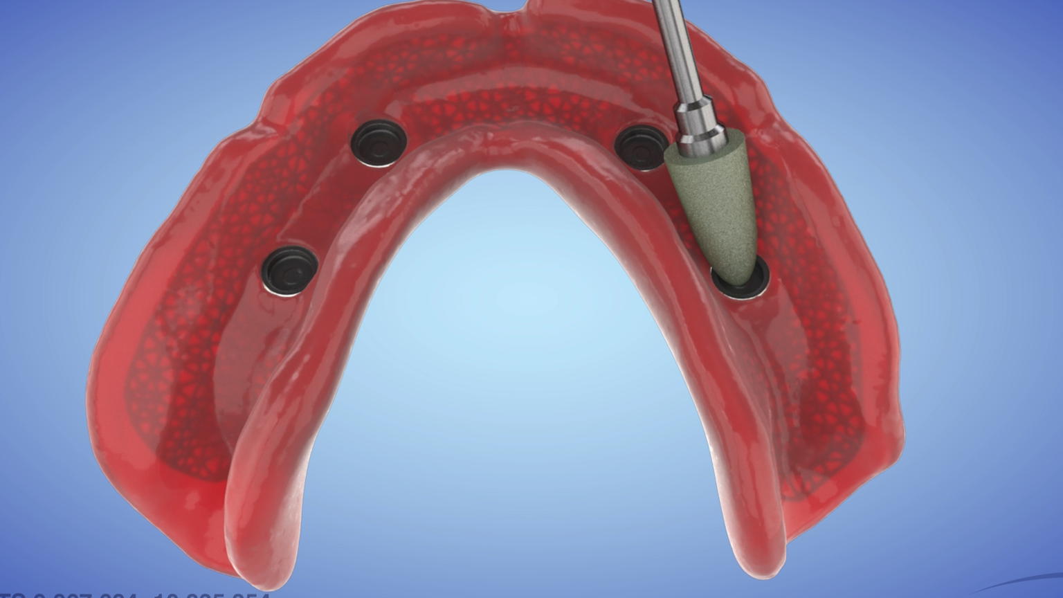 Clinical Pickup Workflow for AvaMax Overdenture with Ti-SpaceTruss Frame 