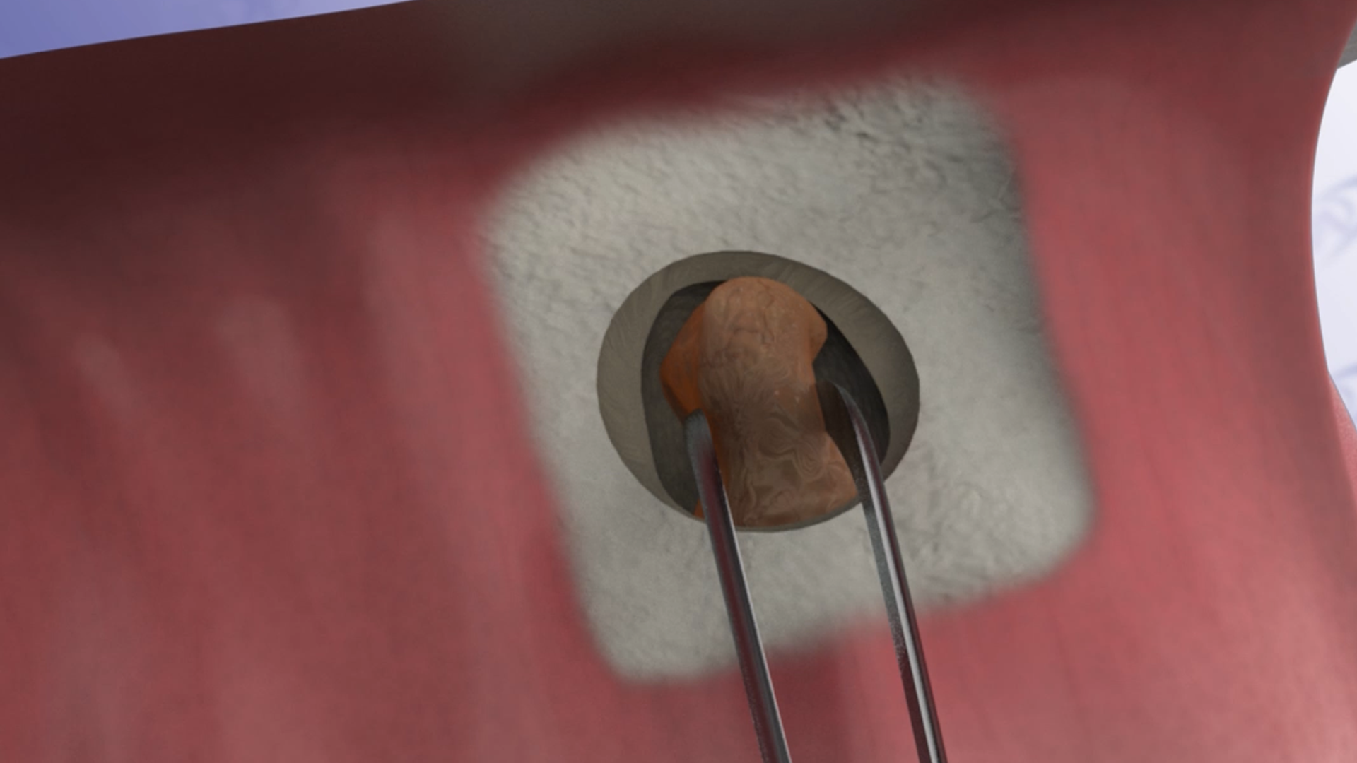 Apicoectomy Procedure