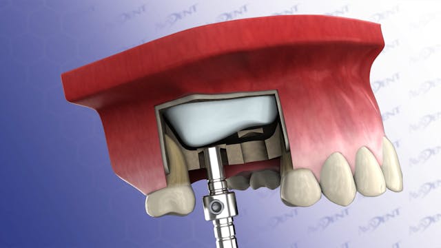 Sinus Lift with Vertical Approach - S...