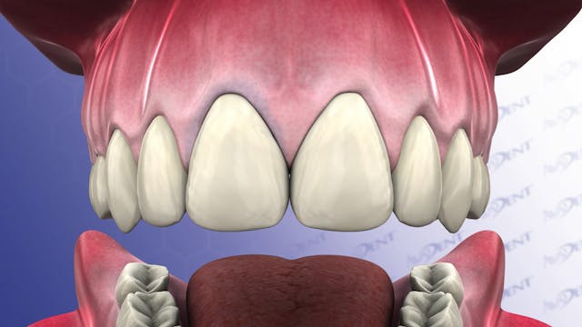 Metal-Ceramic vs. All-Ceramic Crowns