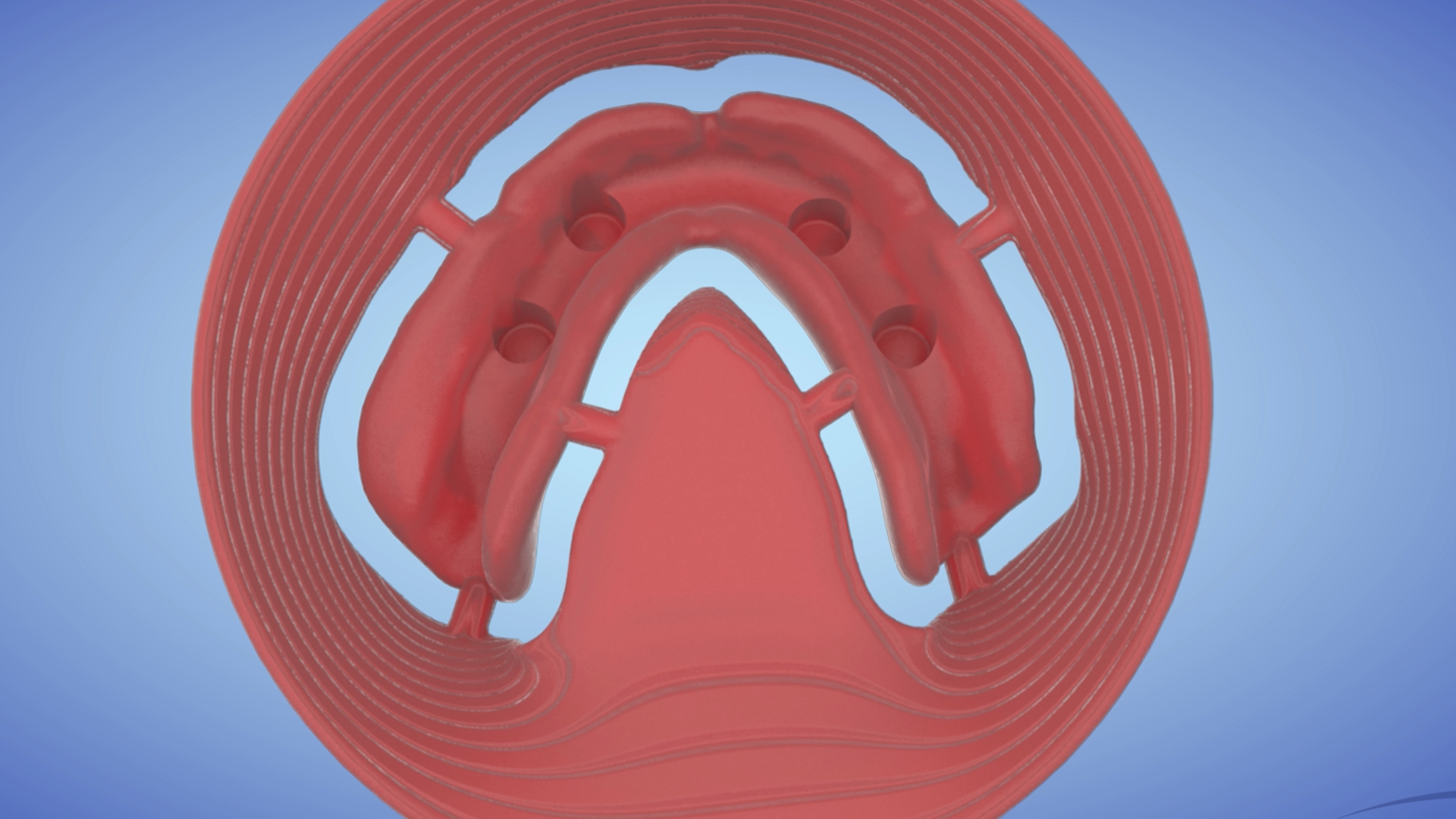 AvaMax Overdenture Ti-SpaceTruss Frame