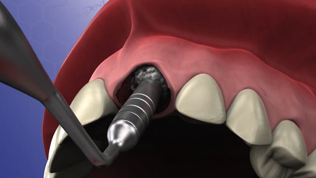 Bone Grafting for Socket Preservation...