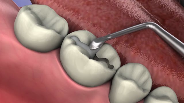 Dental Sealants