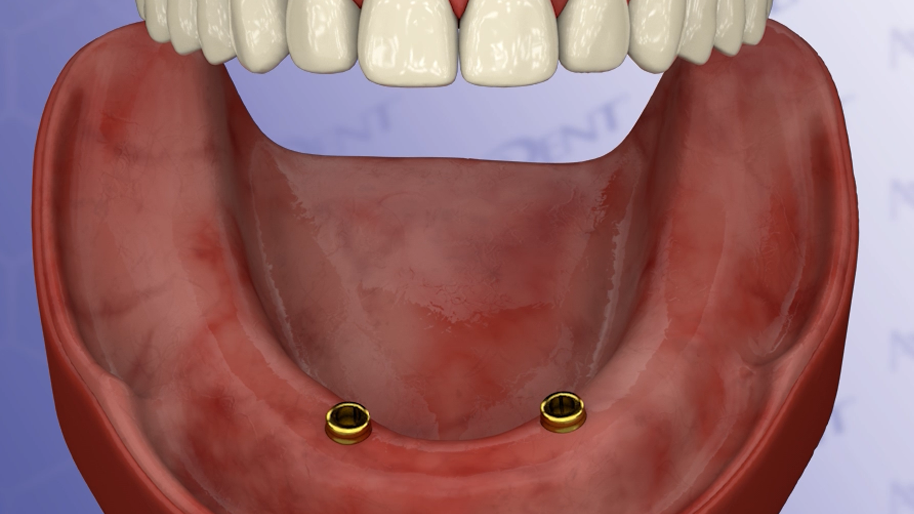 Two Implant-Supported Over Denture