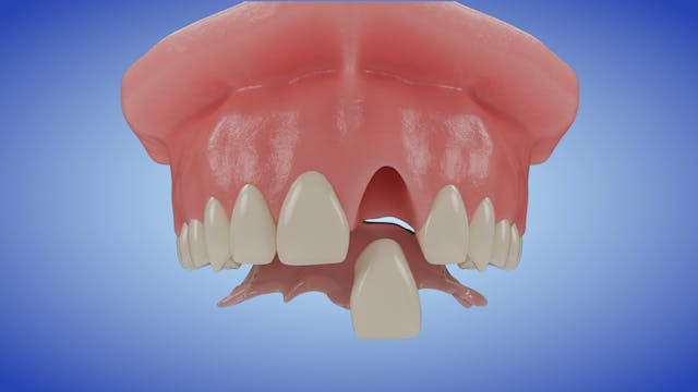 Provisional (Flipper) Denture 