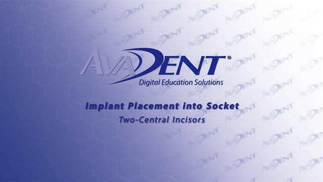 Implant Placement into Socket - Two C...