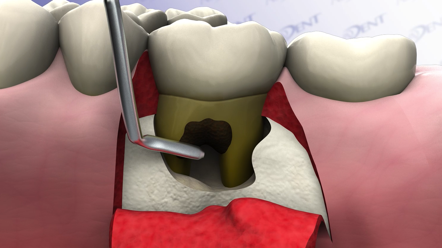 Bone Grafting of a Furcation