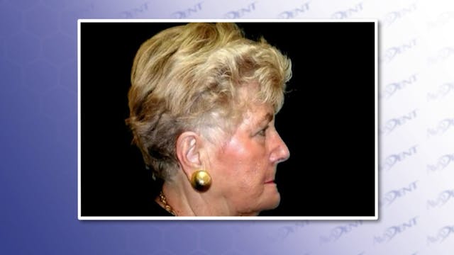 Premature Aging Do To Bone Loss - Fem...