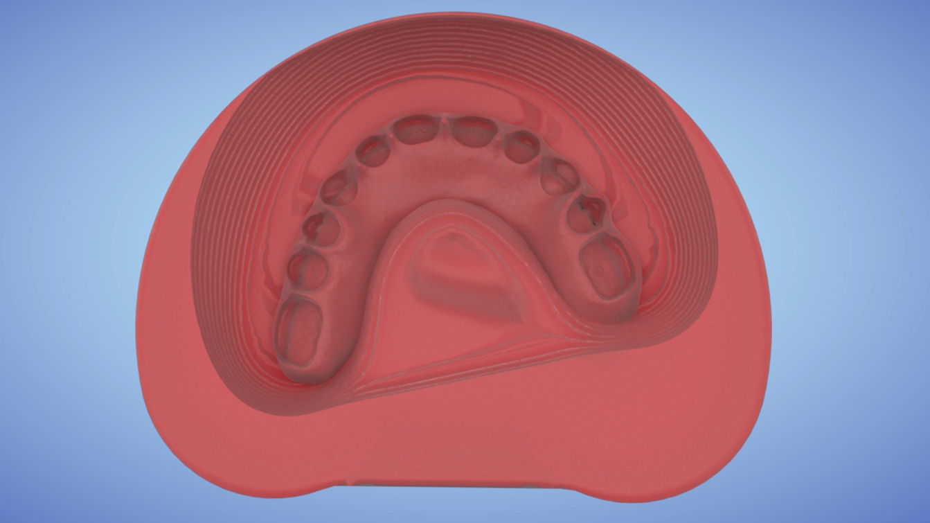 AvaMax Hybrid Prothesis with LOCATOR FIXED® Ti-SpaceTruss Bar