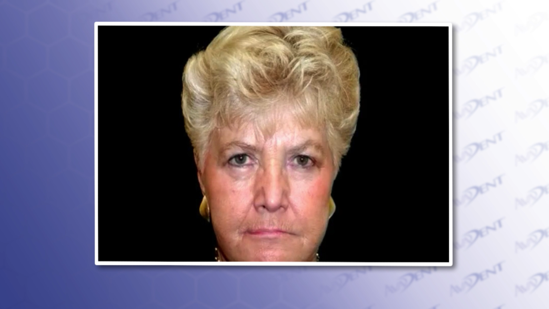 Premature Aging Do To Boneloss - Female Front View