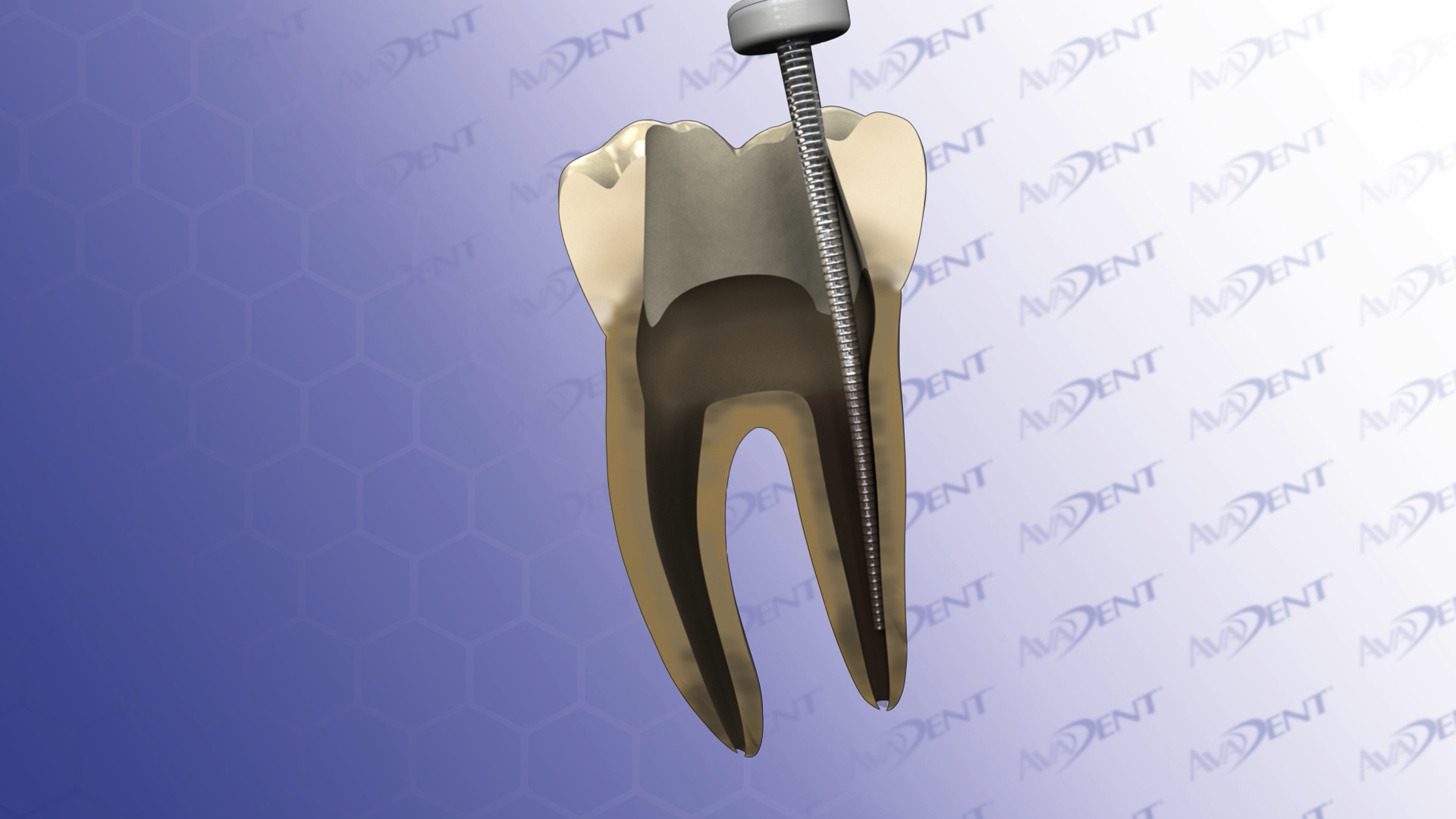 Root Canal Molar