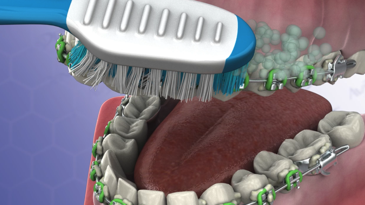Brushing with Braces