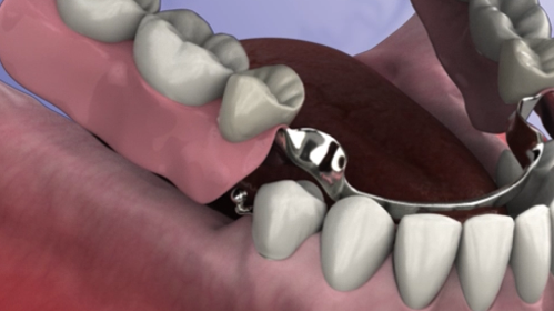 Removable Precision Partial Denture