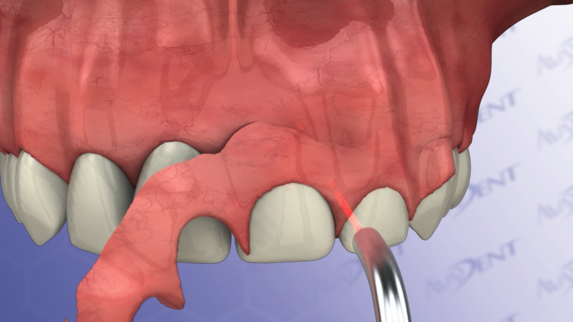 Gingivectomy with Diode Laser