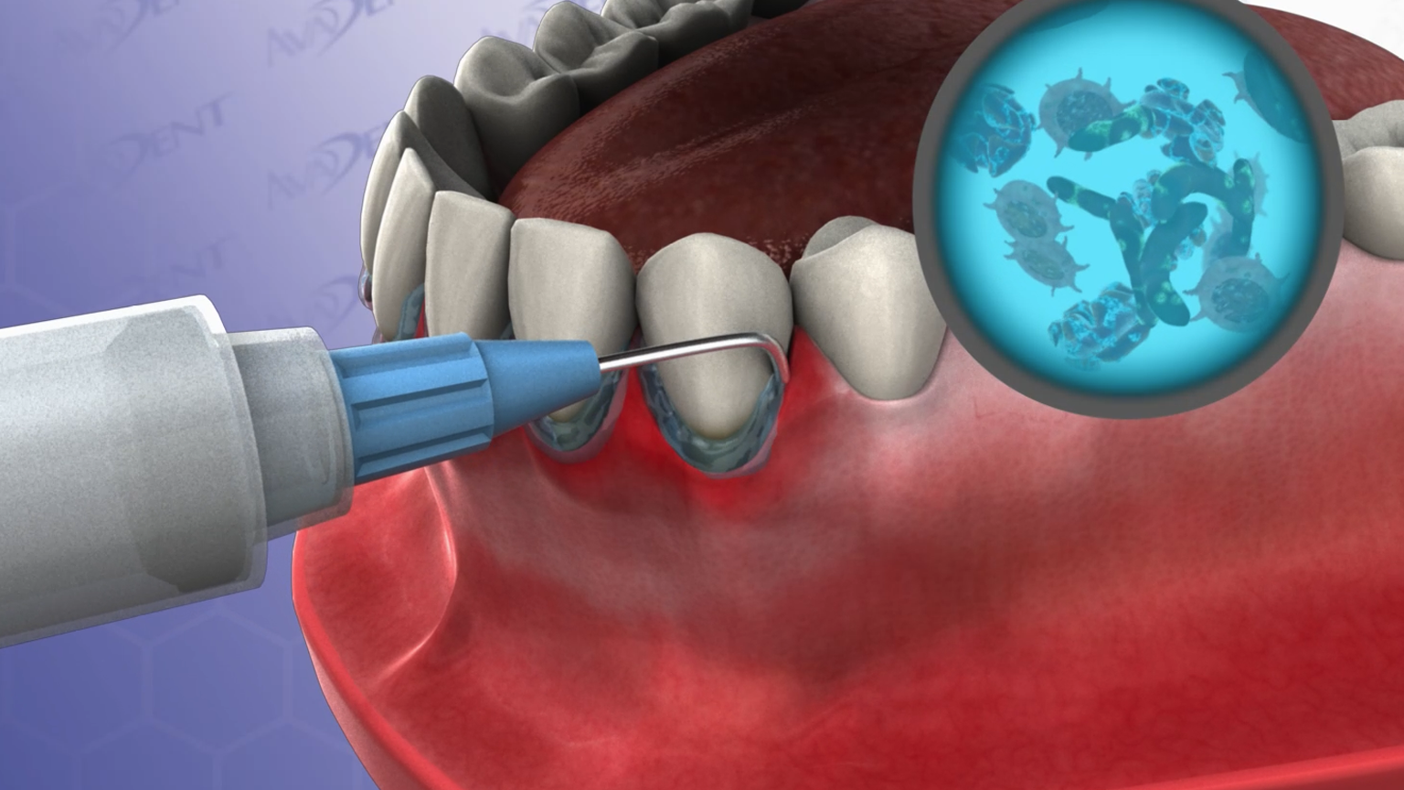Periowave™ Procedure - Six Lower Anterior Teeth