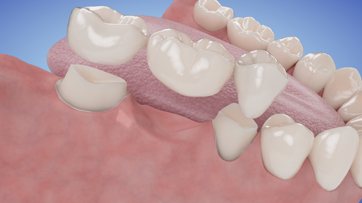 Posterier Three-Unit Bridge