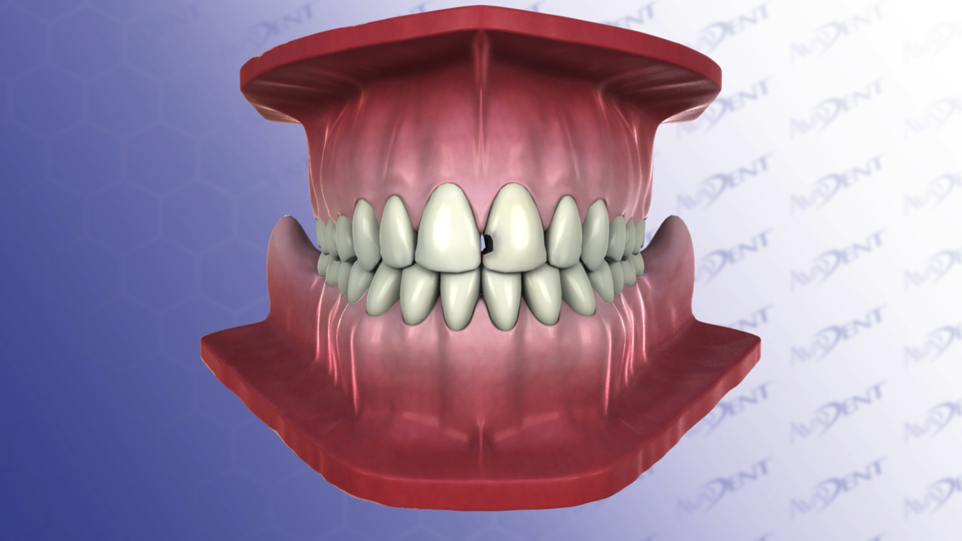 Anterior Bonding Class III