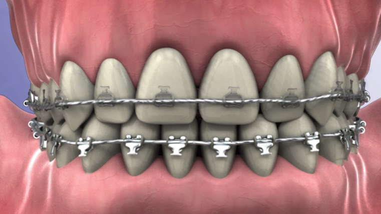 Clear vs. Metal Braces