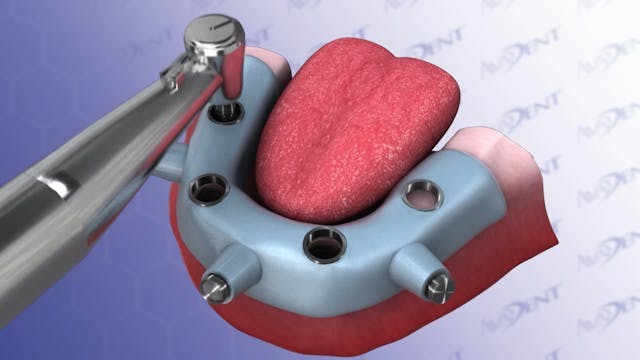 Lower Guided Fixed Detachable