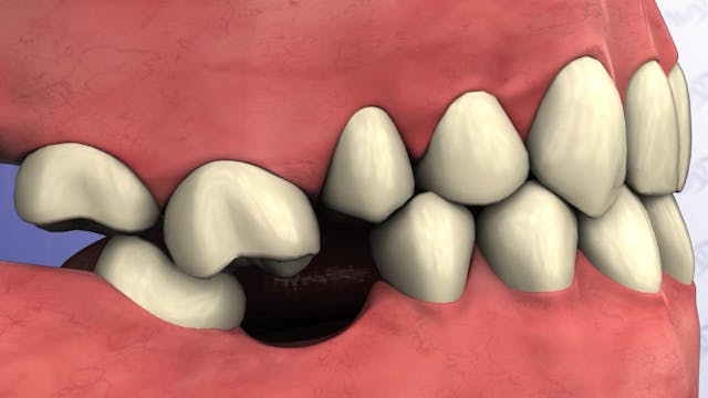Effects of Single Tooth Loss