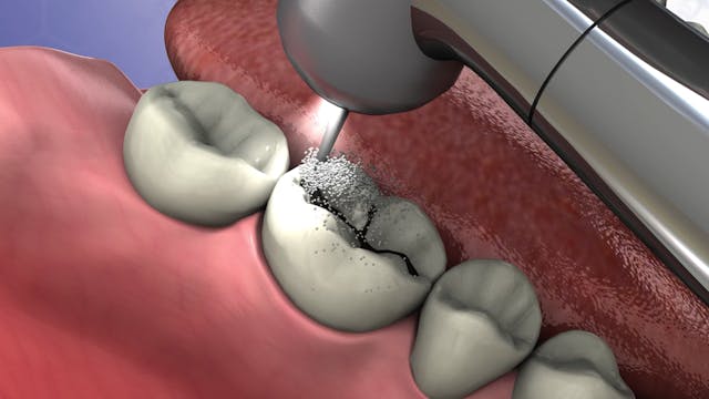 Dental Sealants - with Drill