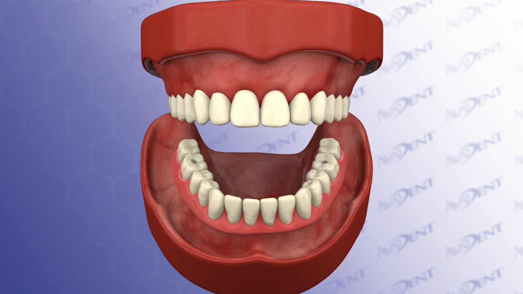 Lower Fixed Detachable