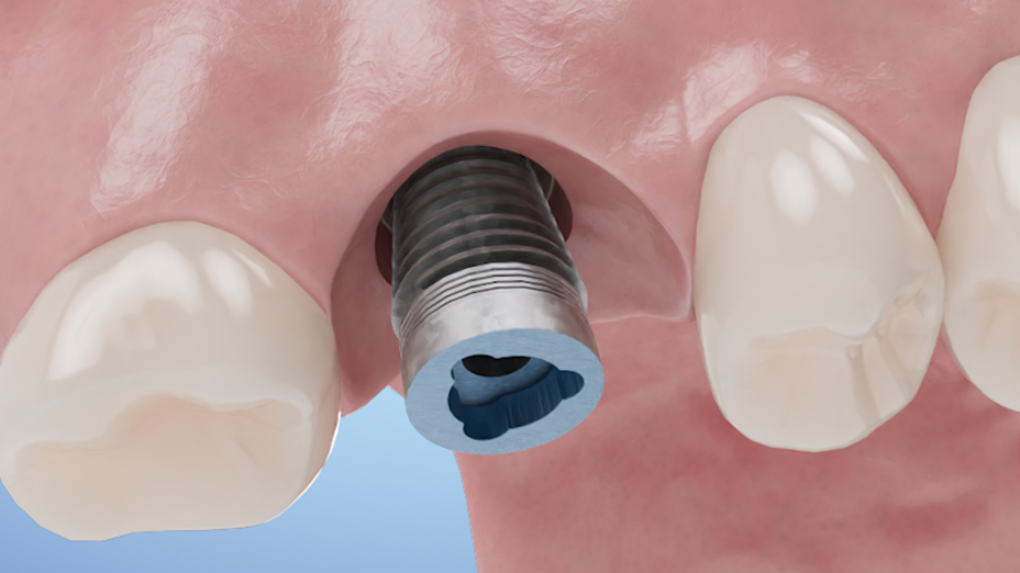 Single Implant for Upper Posterior