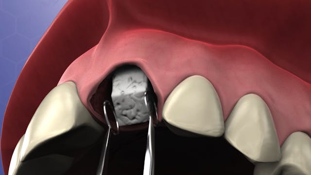 Bone Grafting for Socket Preservation...